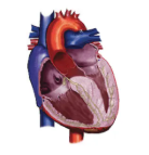 Diagram of HCM heart with obstruction